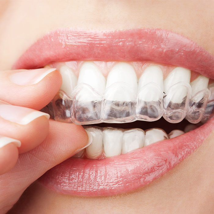 Invisalign