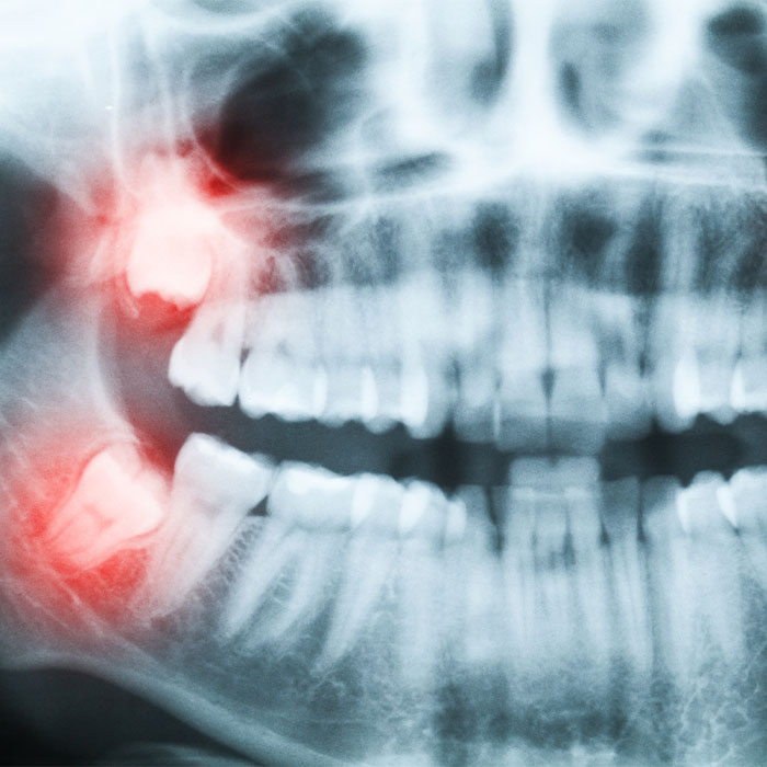 Wisdom Teeth Extraction bonnie doon