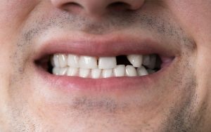 82 Dental - Patient with a knocked out tooth